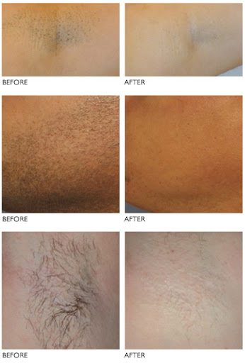NuBody_IPL_Before_After_Image01.jpg